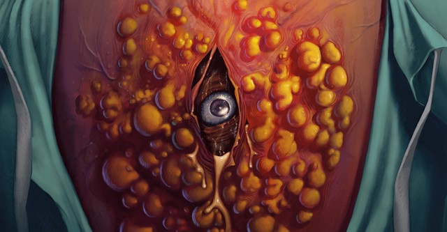Cyst
