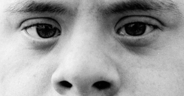 Up Syndrome