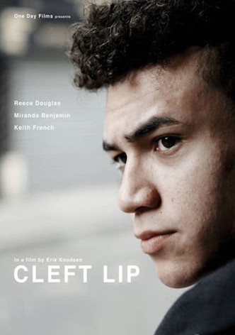 Cleft Lip