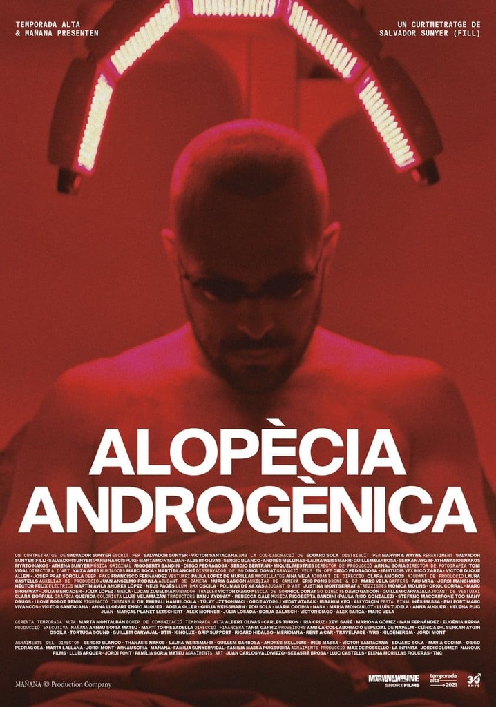Androgenic Alopecia
