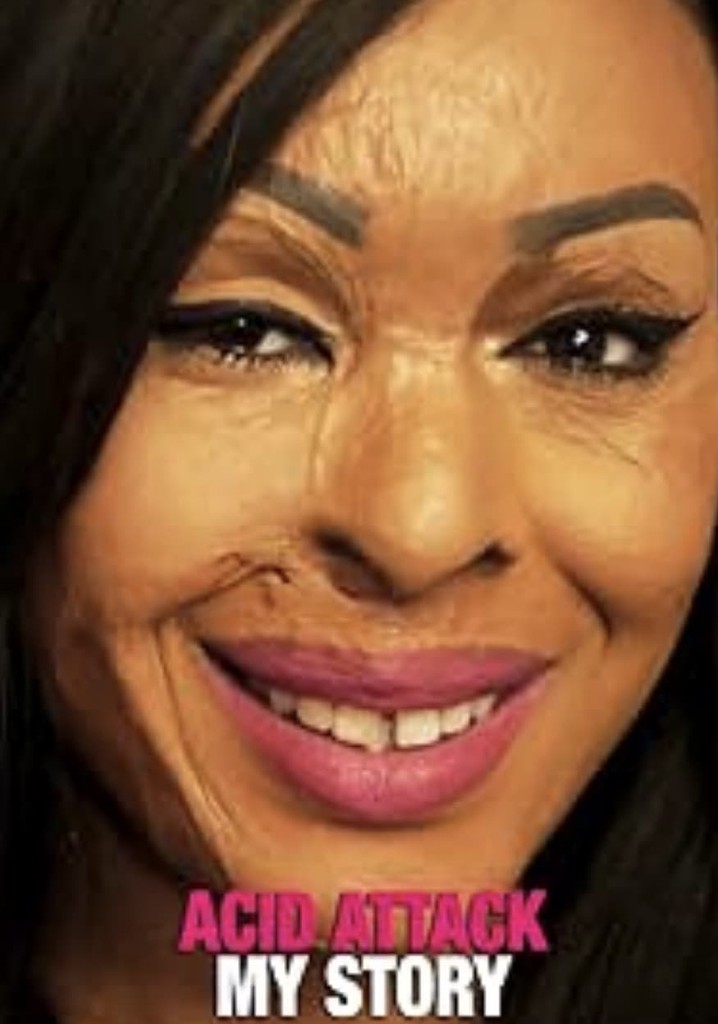 Acid Attack: My Story