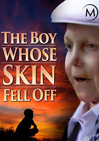 The Boy Whose Skin Fell Off