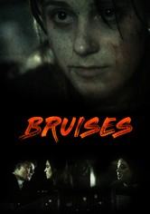 Bruises