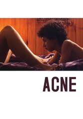 Acne